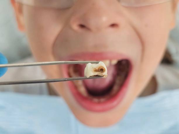 Best Emergency Dentist for Lost Fillings or Crowns in Littlefield, TX